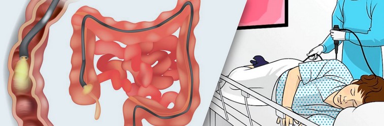طرق تشخيص التهاب القولون عند الأطفال